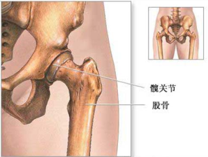 股骨头坏死保守治疗如何选药？这一成分得到有效应用